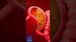 Gastroesophageal reflux disease  GERD Short Explanation [upl. by Kenay814]