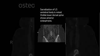 Sacralization of L5 vertebral body is noted spinesurgeon neurosurgeon orthopedicsurgeon [upl. by Luehrmann]