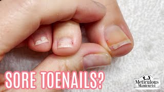 Toenail Fungus Cleaning at Home Success [upl. by Krista528]