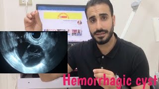 Level 3  Female pelvis  Gyn  Ovary  Hemorrhagic Cyst  staging and signs of rupture cyst [upl. by Sylas27]