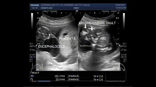 Anencephaly and Encephalocele with a pregnancy of about 16 weeks [upl. by Paris315]