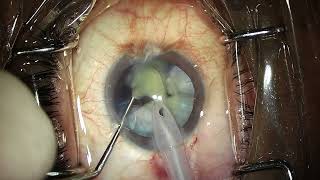 Phaco in Intumescent cataract [upl. by Foster]