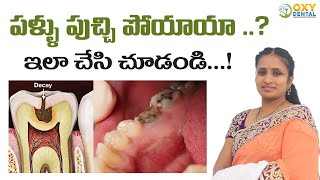 పళ్ళు పుచ్చి పోయాయా   Precautions to be taken to Prevent tooth Decay  Dr Madhuri  Oxy Dental [upl. by Dun203]