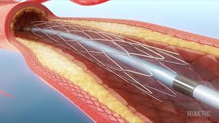 Atherosclerosis medical animation by Geometric Medical [upl. by Atinuahs602]