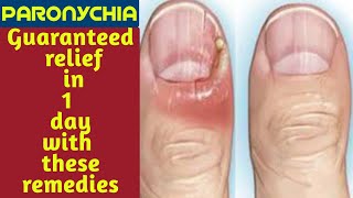 Paronychia finger home remedies  Paronychia fungal nail infection  Paronychia nail home remedies [upl. by Sergent]