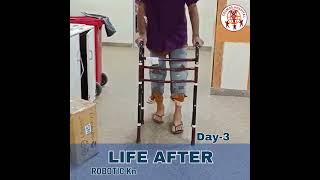 रोबोटिक घुटना प्रत्यारोपण ने बदली जिंदगी  Watch Before and After Surgery Life Step by Step [upl. by Hairahcez]