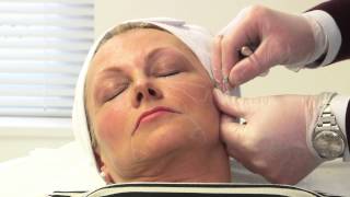 Facial rejuvenation with dermal fillers [upl. by Alf886]