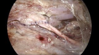 Retroperitoneoscopic pyeloplasty OR Setup port position and retroperitoneal access [upl. by Brice]