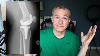 Knee Replacement  Frustrated by Lack of Progress quotWhat should I doquot [upl. by Ami587]