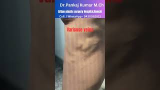 varicose veins treatment with foam Sclerotherapy and Diode laser varicosevein shorts [upl. by Iloj]