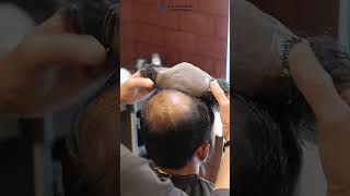 Hair Patch in Pune  Natural Results [upl. by Halet584]