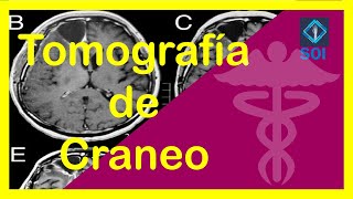 ✅Tomografía de Cráneo 🧠  ☢️ Diagnostico e Interpretación  tomografía de cráneo computarizada👩‍⚕️ [upl. by Magna]