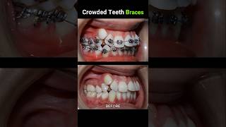 40 months for this braces Crowded teeth braces orthodontist dentist dentistry [upl. by Goda119]