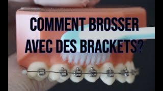 Orthodontie Comment se brosser les dents avec des brackets [upl. by Evad]