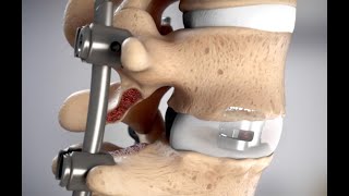 Unleash MIS TLIF System from DePuy Synthes  Ghost Medical Orthopedic Animation [upl. by Garrott]