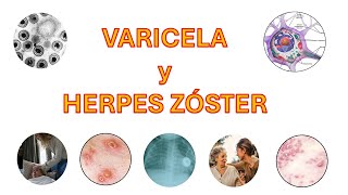 Varicela y Herpes Zóster [upl. by Ahseined116]