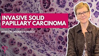 What is Invasive Solid Papillary Carcinoma and How is it Treated [upl. by Amaral109]