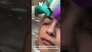 👁️ Láser CO2 para rejuvenecer los párpados ✨ [upl. by Farrow]