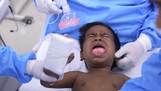 Little Boy with Ranula Cyst Crying amp Scared Before Anesthesia [upl. by Kelwunn405]