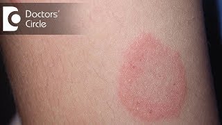 How to manage Chronic Ringworm infection  Dr Rajdeep Mysore [upl. by Fiedling]