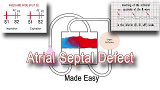 Understanding Atrial Septal Defect ASDA congenital defect atria heart asd congenital health [upl. by Amsden]