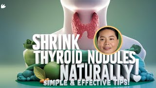 Thyroid Nodules  Causes And Natural Ways To Shrink Thyroid Nodules Hypothyroidism  Thyroid [upl. by Birkett]