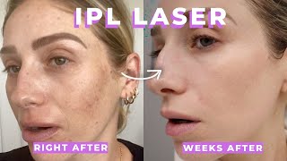 IPL  CLEAR AND BRILLIANT LASER REVIEW  What are they Are they painful Is it worth it [upl. by Darya57]