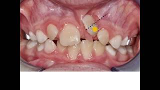 🔥Unexpected orthodontic impaction 🔥 [upl. by Kinom]