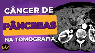 CÂNCER de PÂNCREAS Neoplasia Pancreática na Tomografia Computadorizada TC de Abdome e Pelve [upl. by Sisely907]