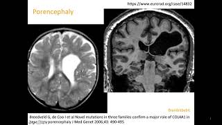 10 Schizencephaly porencephaly COL4A1 mutation congenital CMV open lip closed lip birth defect [upl. by Alleb]