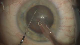 20241127 103444 phaco ASX6 cornea guttata [upl. by Anul]