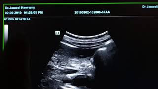 Ureteric Stone Sonography [upl. by Yalhsa]