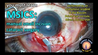 MSICS manual small incision cataract surgery [upl. by Gilboa]