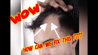 😀😱😳 Receding Hairline Hair Loss THE SOLUTION 😀😱😳 [upl. by Namron171]