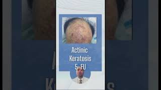 Actinic keratosis AK [upl. by Nadab372]