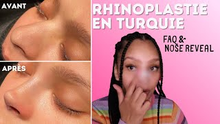 RHINOPLASTIE EN TURQUIE  Prix douleurs chirurgien [upl. by Aidnyl]