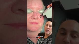 Vbeam for Facial Broken Capillaries [upl. by Starlene]