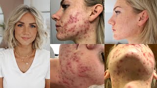 How I Cured My Adult Hormonal Cystic Acne Naturally no accutane [upl. by Elizabeth]