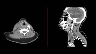 Internal jugular thrombophlebitis [upl. by Fabri559]