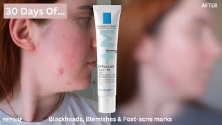 30 DAYS OF La RochePosay Effaclar Duo for Blemishes Blackheads amp PostAcne Marks One Month Review [upl. by Yrod]