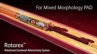 Rotarex™ Rotational Excisional Atherectomy System MoA video [upl. by Ezirtaeb899]