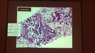 Small biopsies big deal practical approach to lung cancer diagnosis [upl. by Doomham]