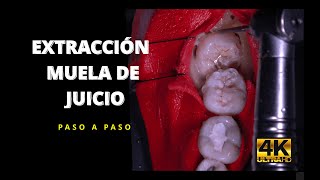 EXTRACCION MUELA DE JUICIO [upl. by Marcia727]