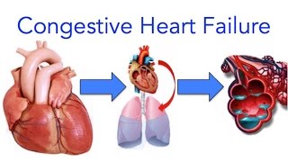 Congestive Heart Failure CHF Explained  MADE EASY [upl. by Shepard]